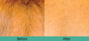 Hair laser results