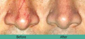 Nose laser results